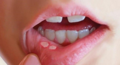 Bài thuốc đông y chữa viêm loét miệng hiệu quả 1