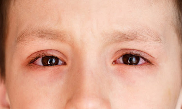 Bệnh đau mắt đỏ 1