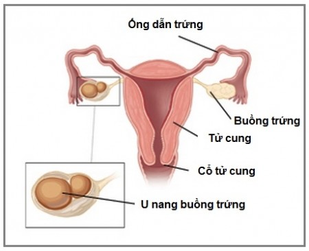 Bệnh lý u nang buồng trứng ở phụ nữ 1
